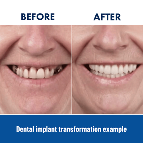 Dental Implants
